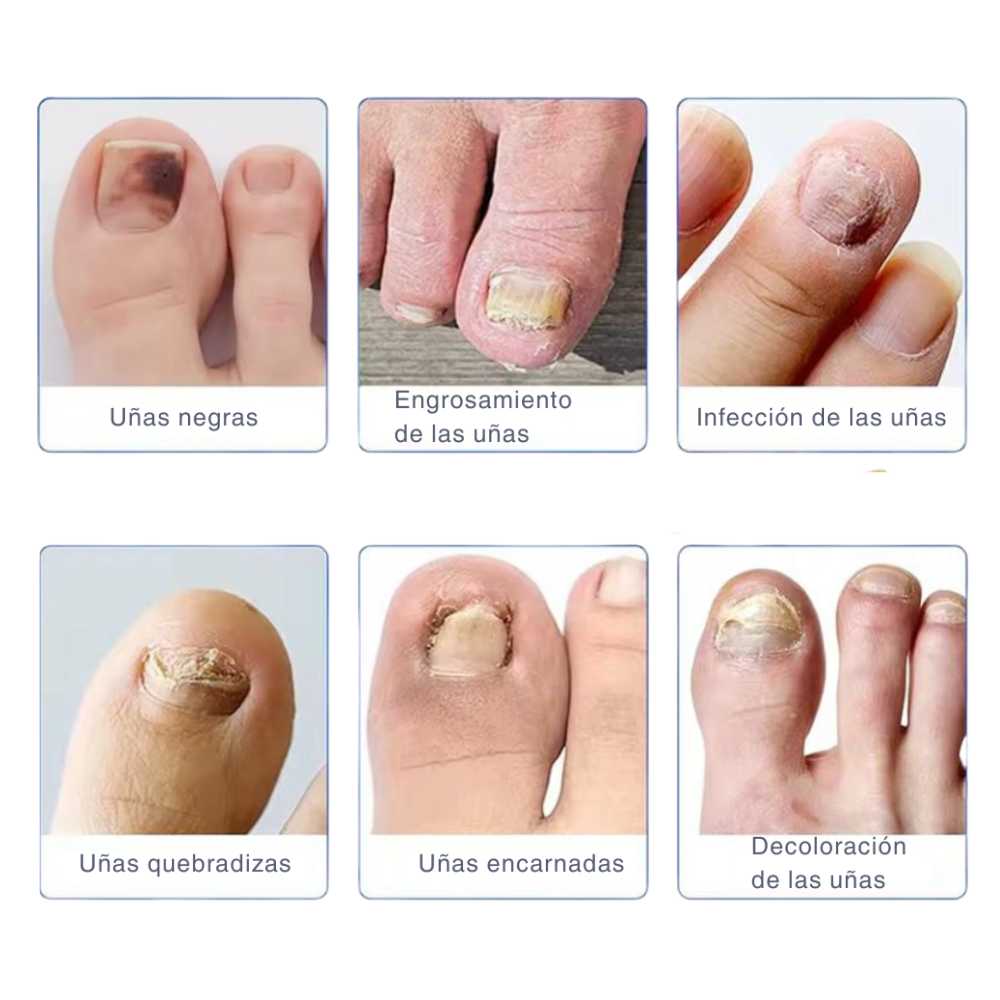 NAILTHERAPY LÁSER