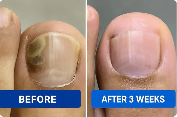 NAILTHERAPY LÁSER